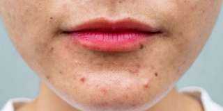 «حب الشباب».. أمور يجب الابتعاد عنها لمواجهة أسوأ كابوس للبشرة